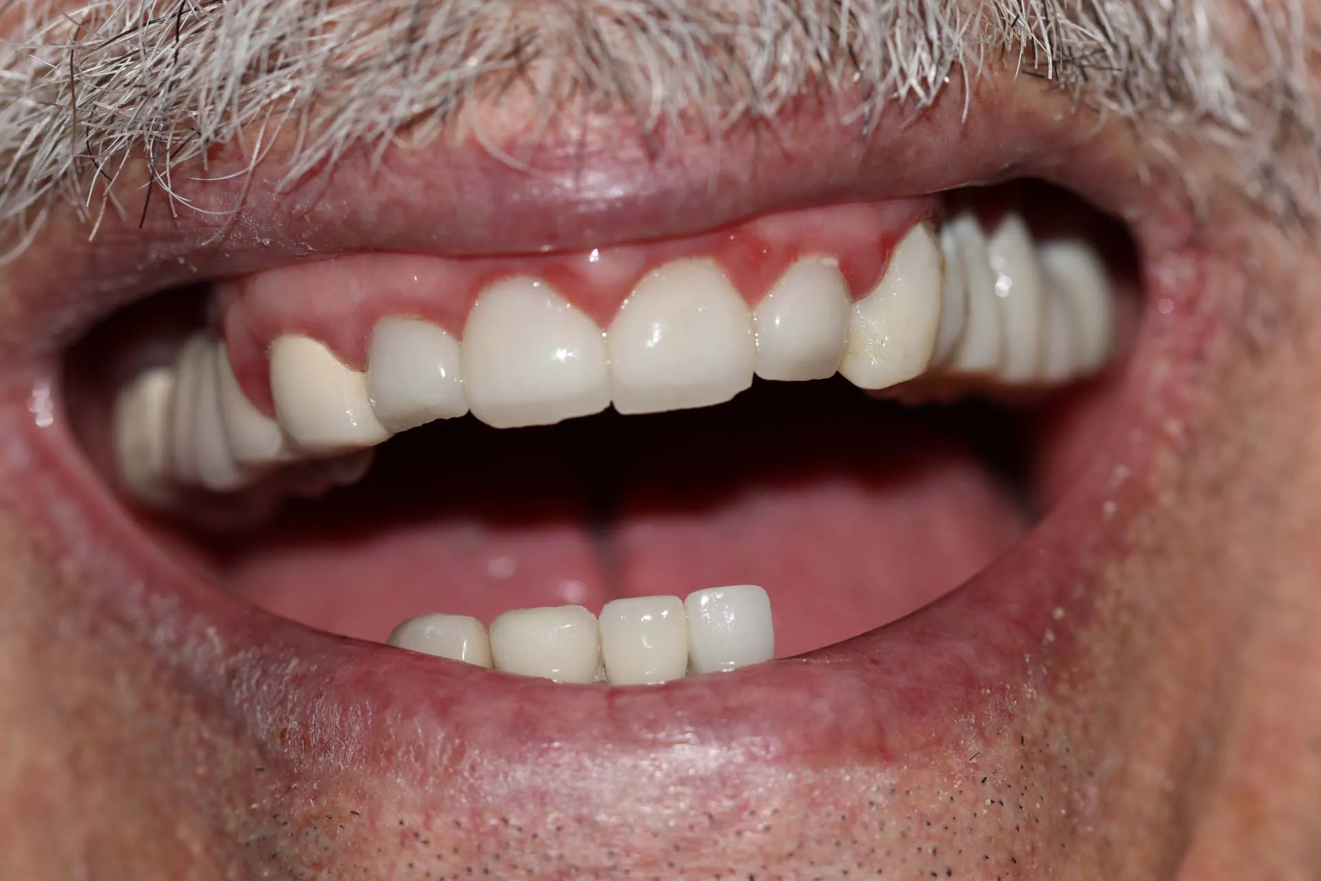 Digital Cosmetic Smile Makeover