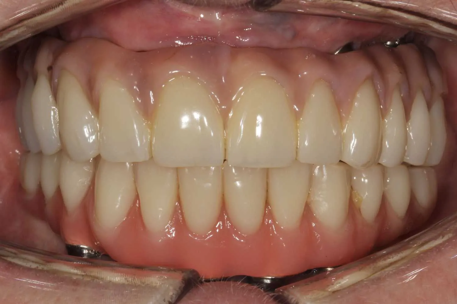 Full Mouth Missing Teeth After – Maida Smiles Dental Clinic