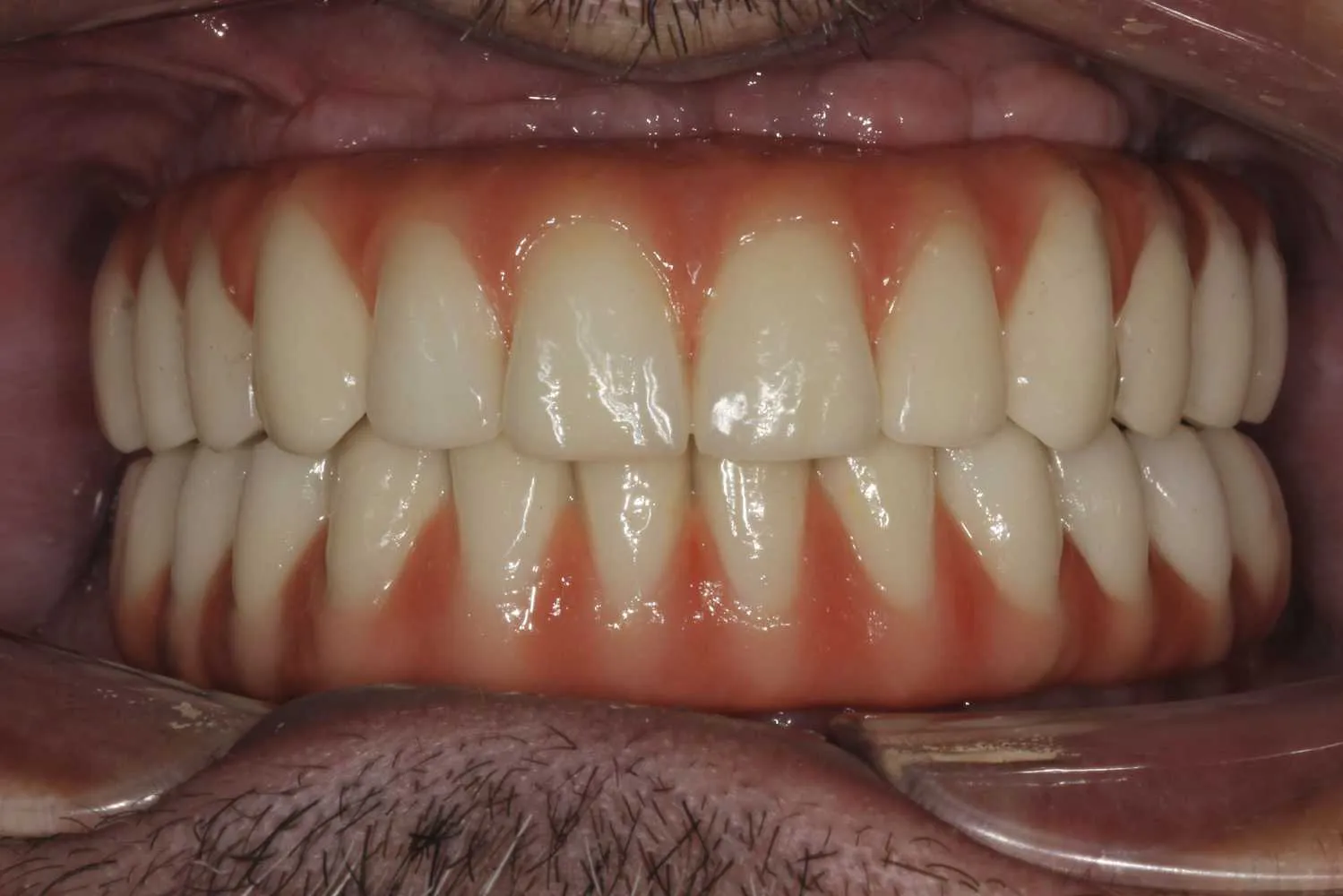 All on 4 Before and After – Maida Smiles Dental Clinic