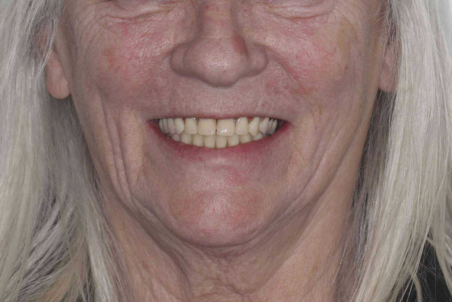 Missing Lower Teeth After – Maida Smiles Dental Clinic