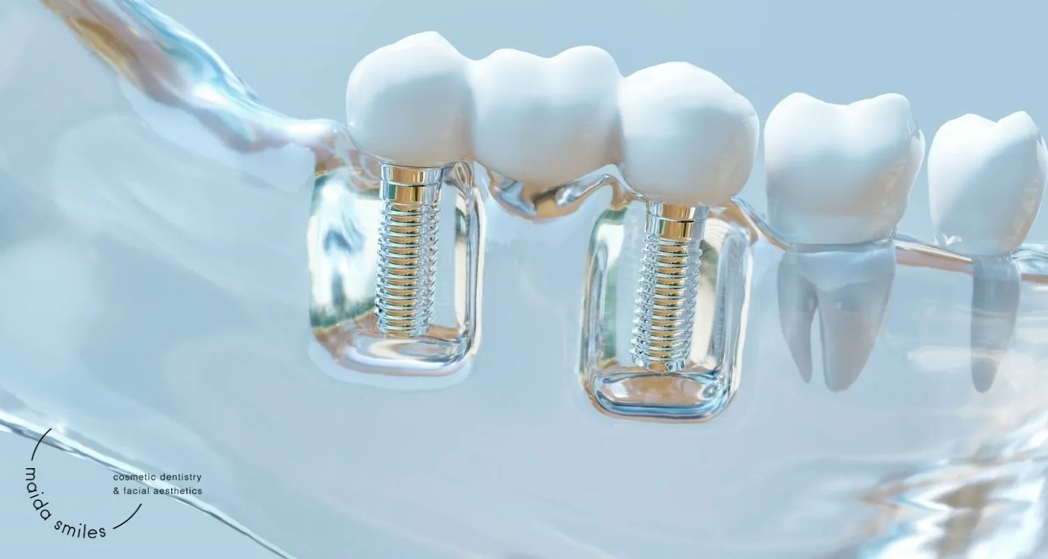Dental Implant Example Image – Maida Smiles Dental Clinic