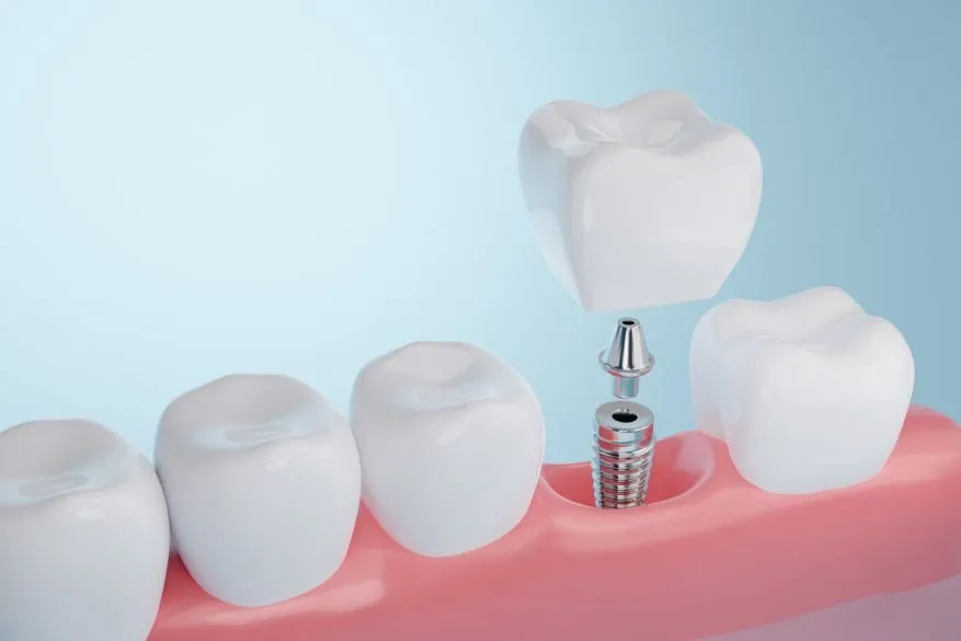 Single Implants – Maida Smiles Dental Clinic