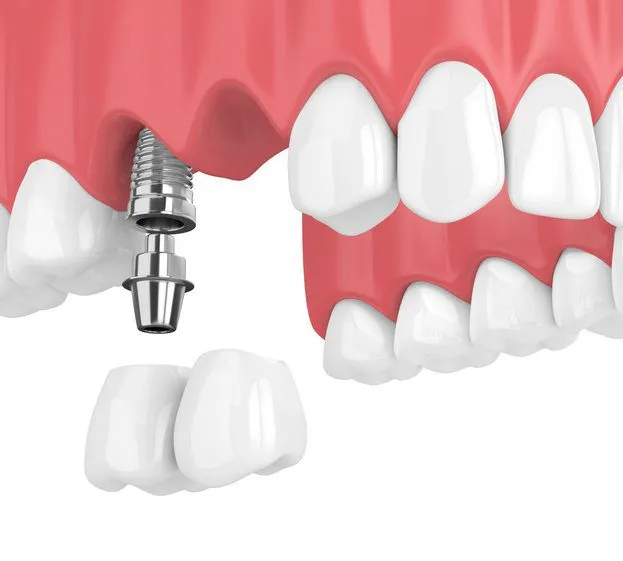 Implant Bridge – Maida Smiles Dental Clinic