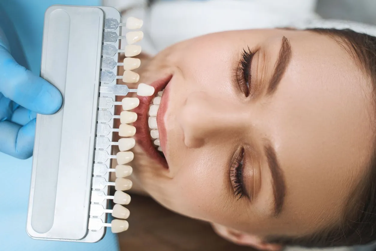 Porcelain Veneer Shade Match – Maida Smiles Dental Clinic
