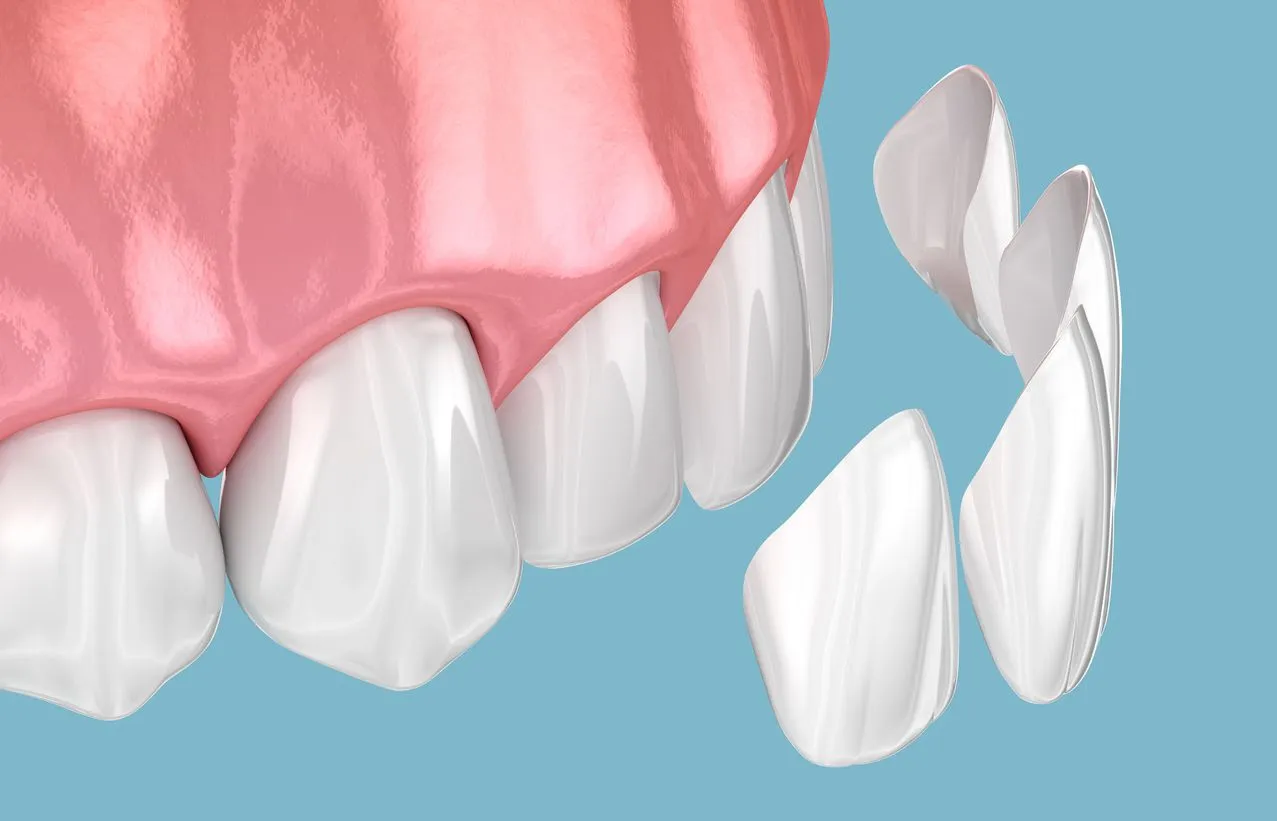 Image of Composite Veneers – Maida Smiles Dental Clinic