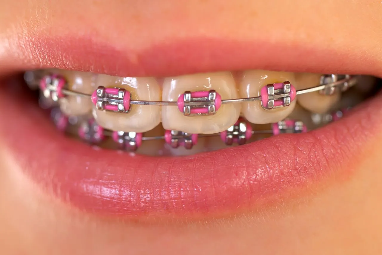 Metal Braces – Maida Smiles Dental Clinic
