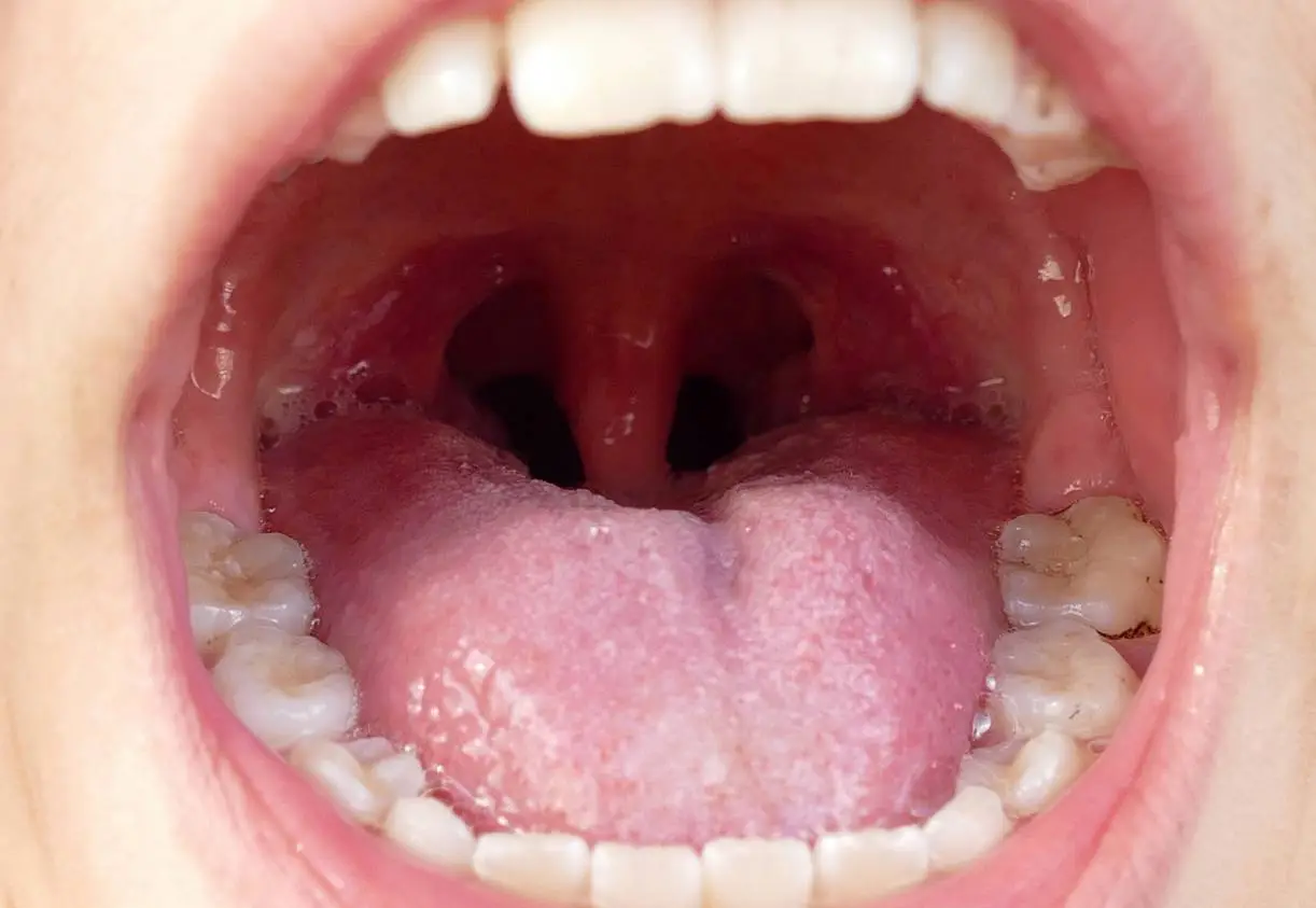 Gag Reflex Image – Maida Smiles Dental Clinic