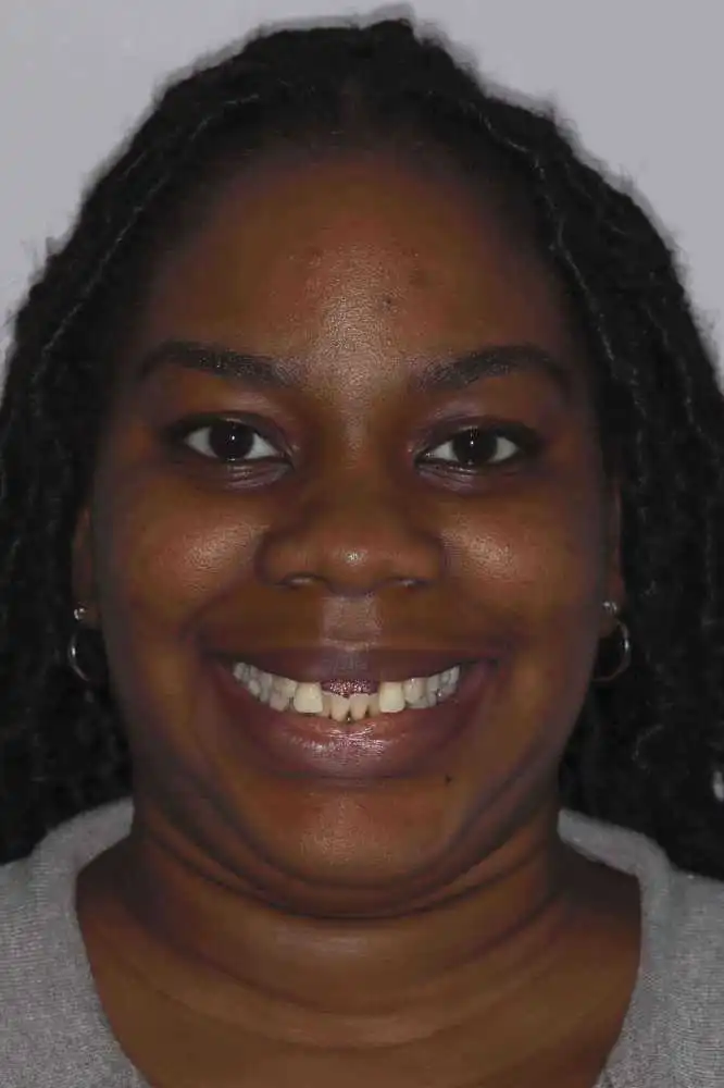 Portrait of a smiling female patient's case for replacing two missing front teeth