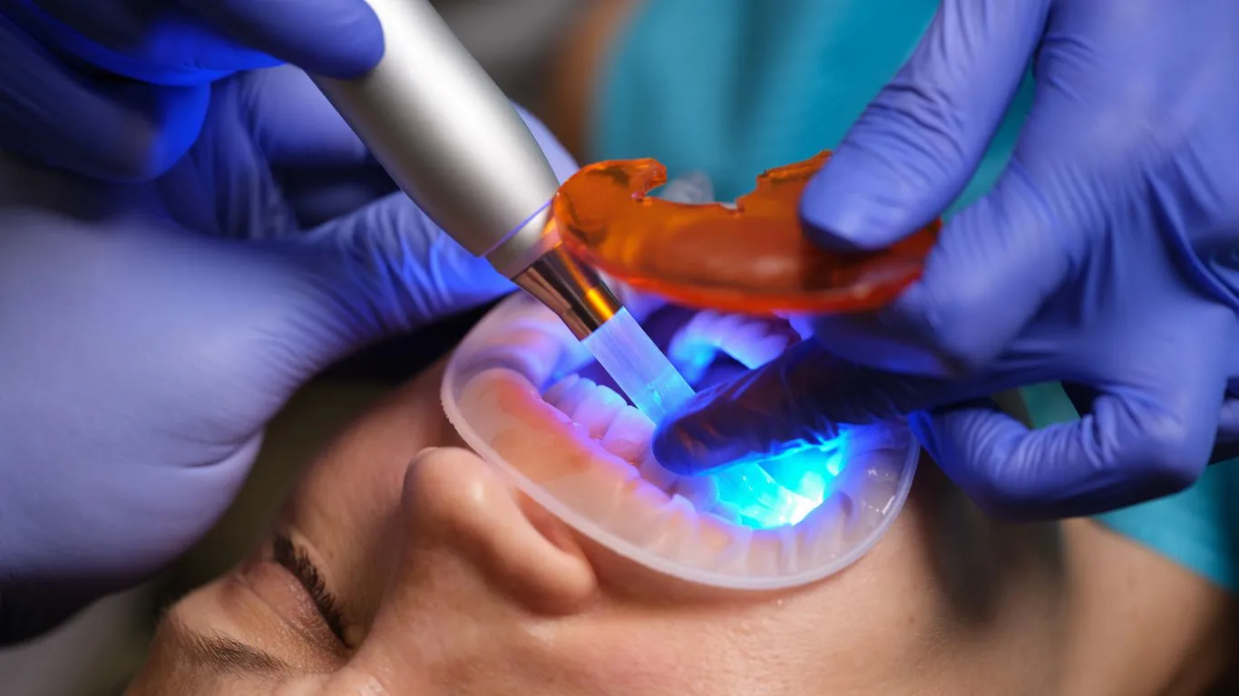 Dentist using a curing light to set composite veneer material on a patient's teeth