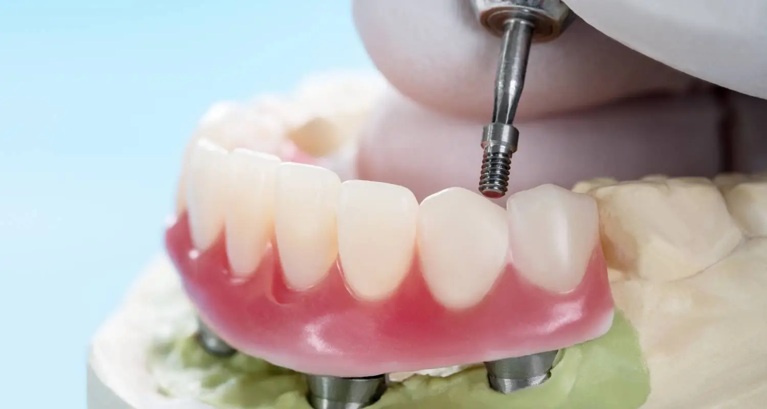 Model of an implant-supported denture showing the arch secured onto implant posts