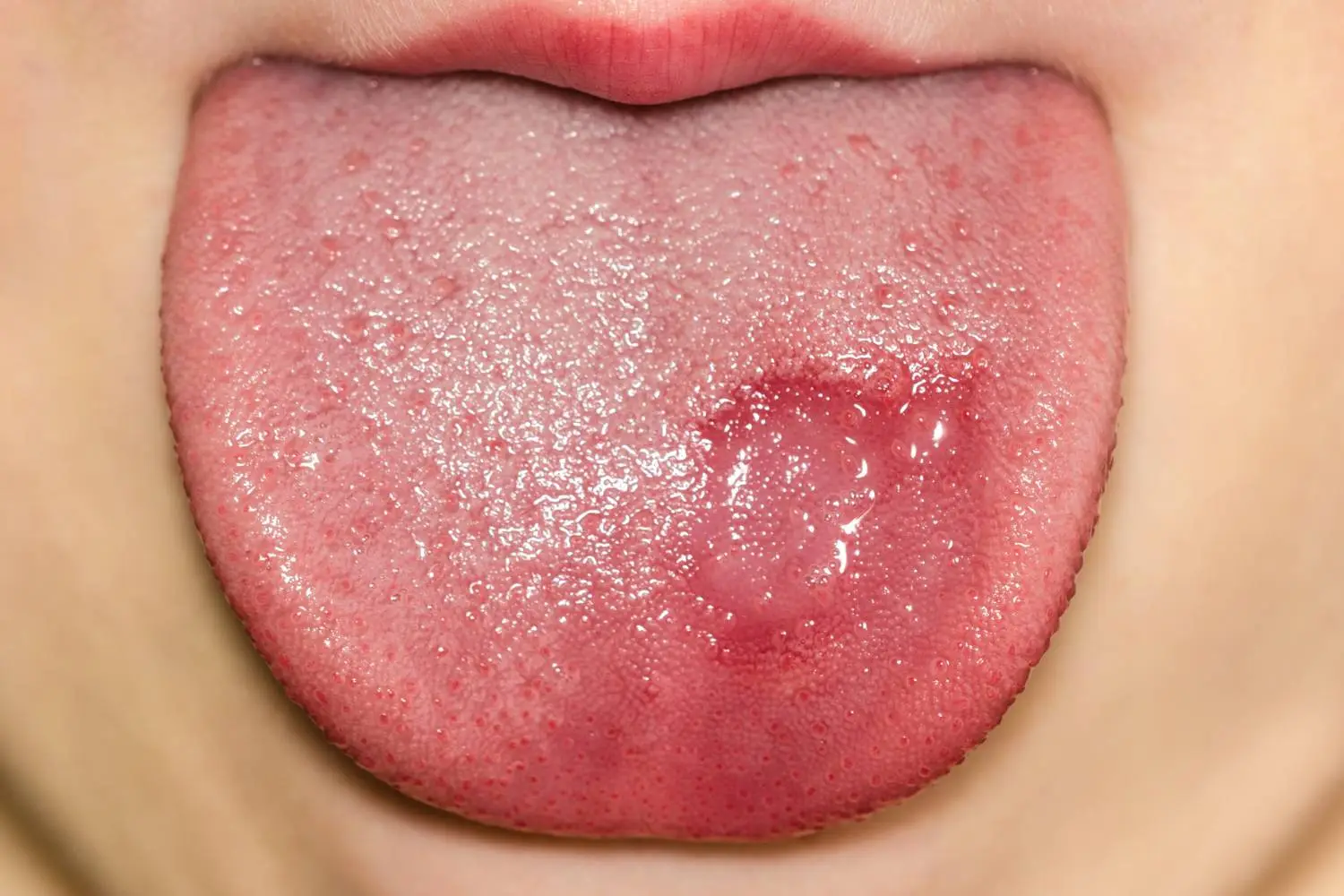Close-up of a patient's tongue showing signs of dryness and irritation associated with salivating and dry mouth