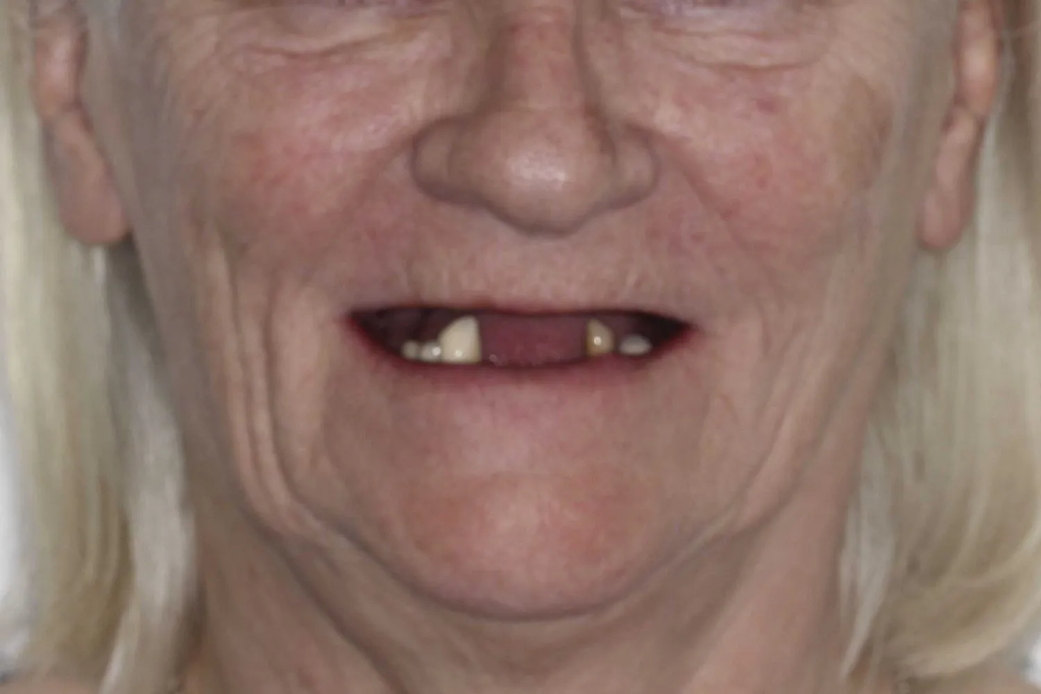 Before photo of an older patient's smile showing missing lower front teeth