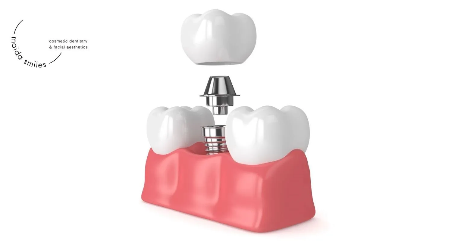 3D illustration of a dental implant crown being fitted onto an implant post in the gum