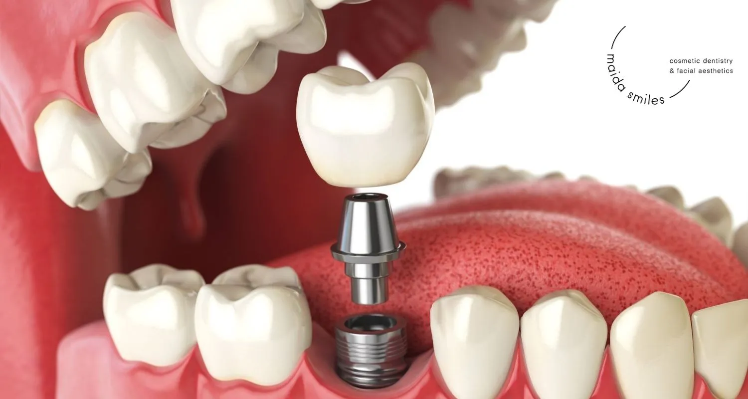 3D illustration of a single dental implant with crown being placed into the jaw between natural teeth