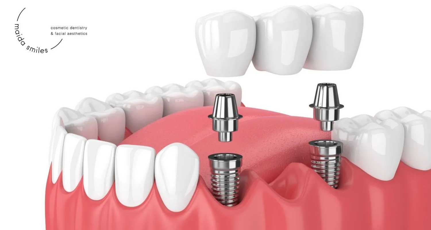 3D illustration of an implant-supported dental bridge replacing three missing teeth