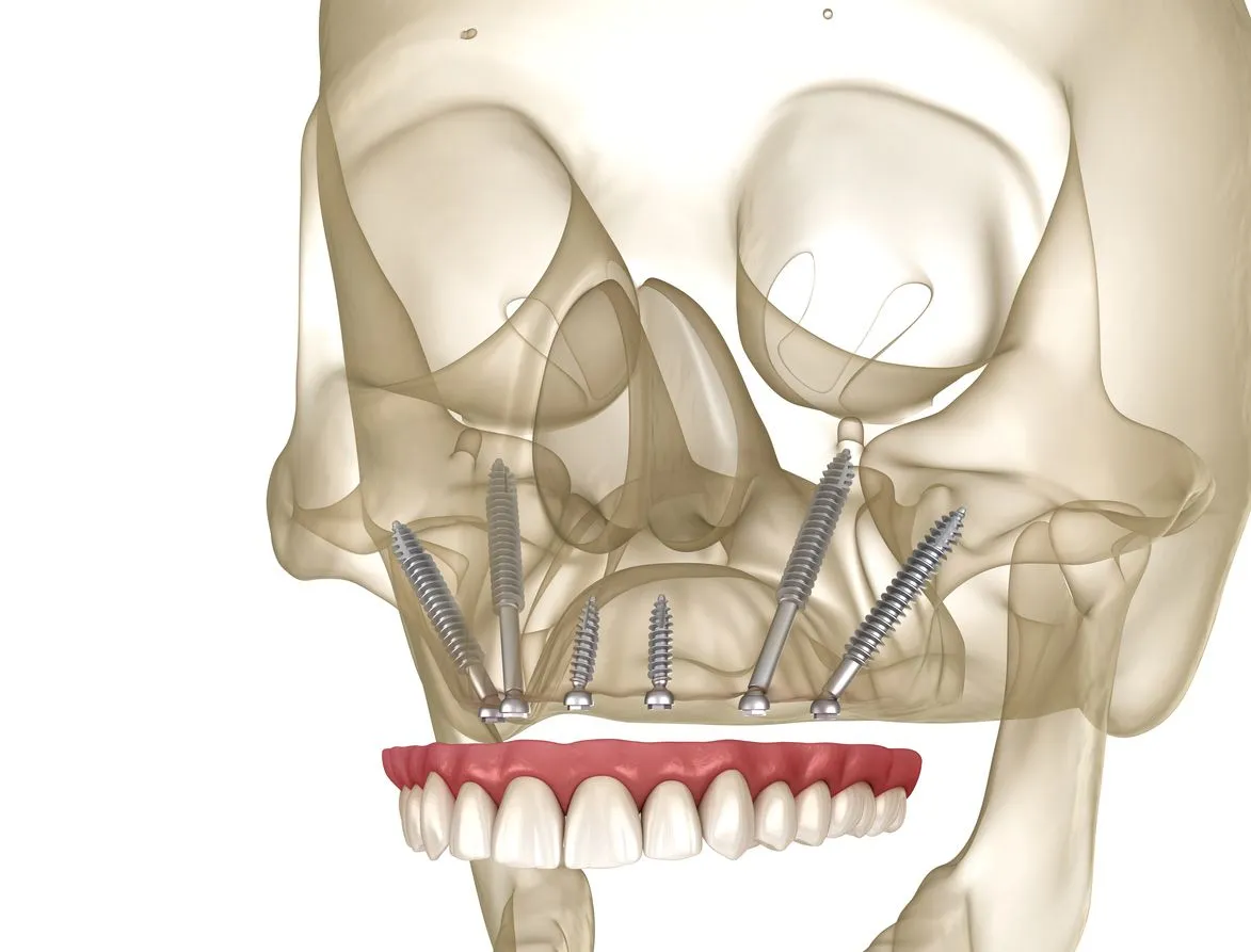 3D illustration of zygomatic dental implants anchored into the cheekbone with a full lower denture attached