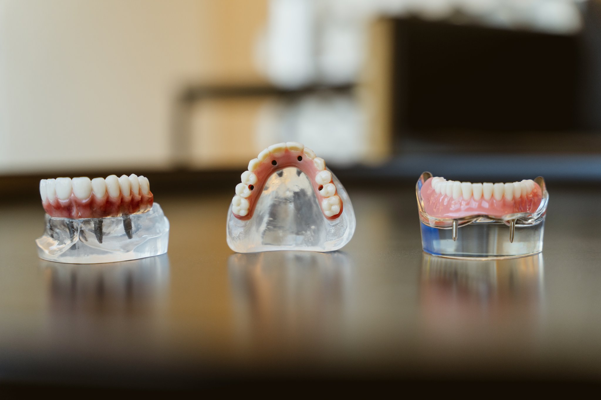 Three dental models showing different implant-retained denture designs on a clinic table