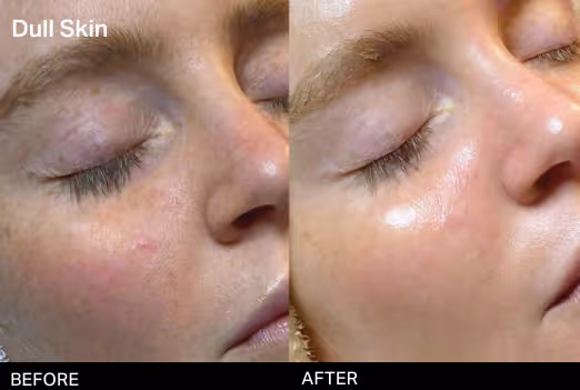 Before and after images showing improved skin glow and smoothness from HydraFacial at ThrIVwell