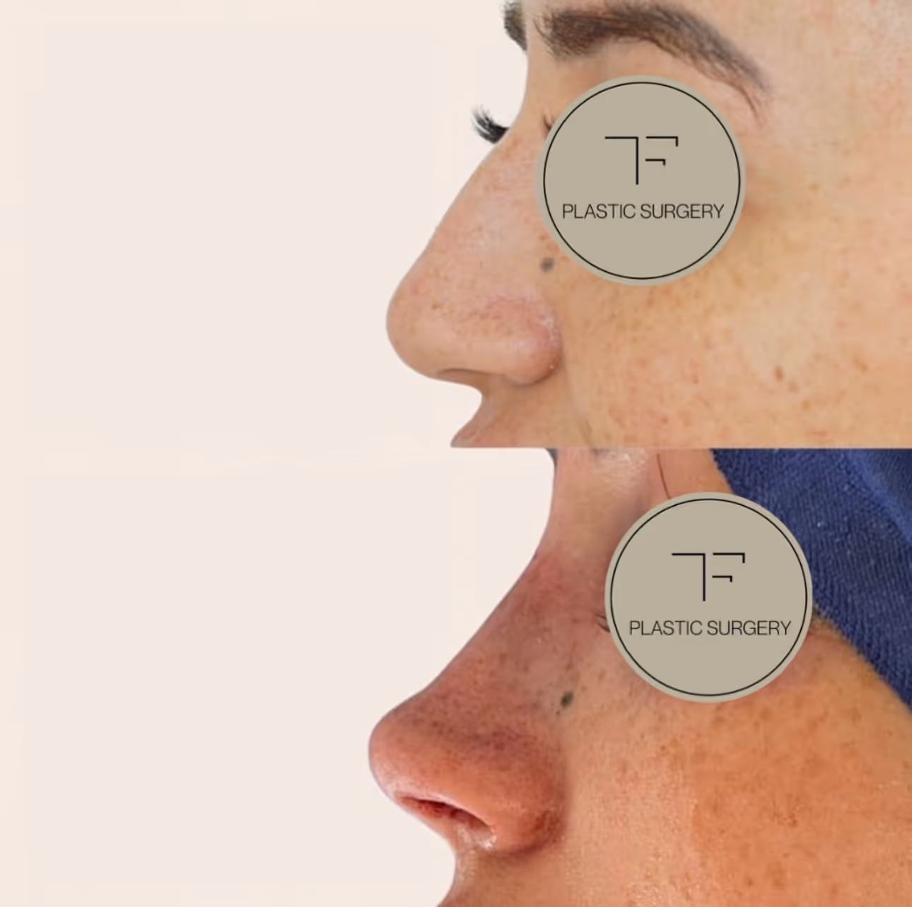 TF Plastic Surgery accompanies you on your journey to a self-confident self – with the most modern methods, individual consultation and the highest medical standards.