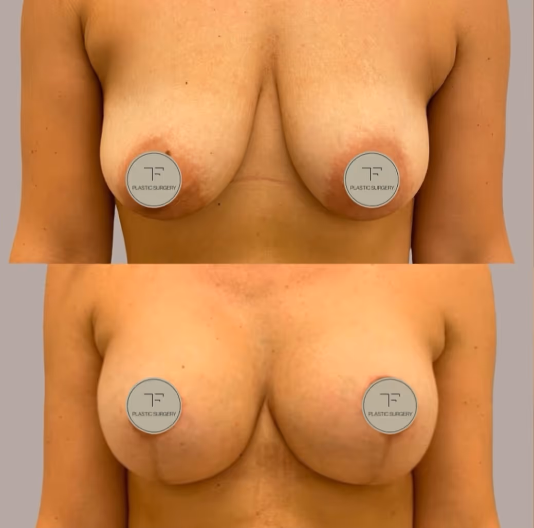 TF Plastic Surgery accompanies you on your journey to a self-confident self – with the most modern methods, individual consultation and the highest medical standards.