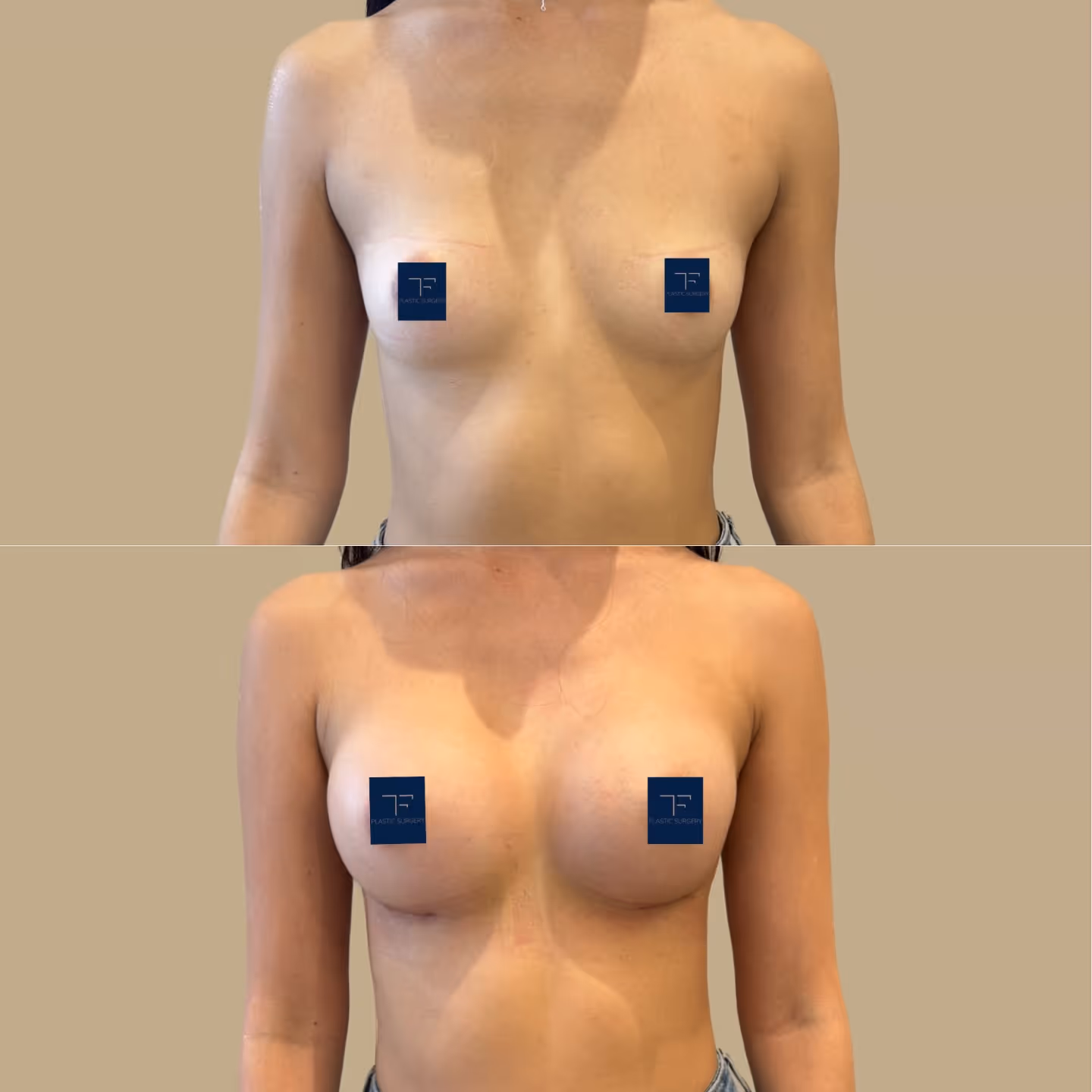 TF Plastic Surgery accompanies you on your journey to a self-confident self – with the most modern methods, individual consultation and the highest medical standards.