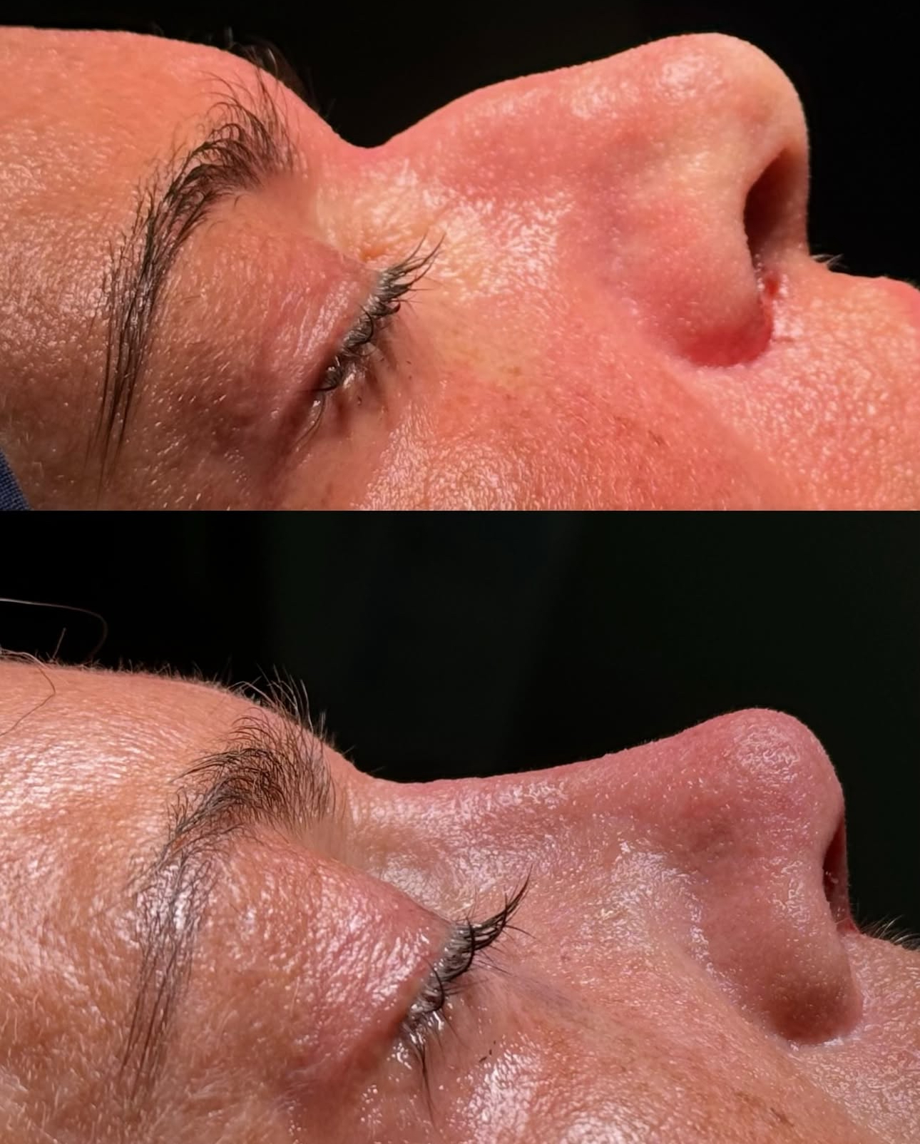 nasenkorrektur-dr.wenny