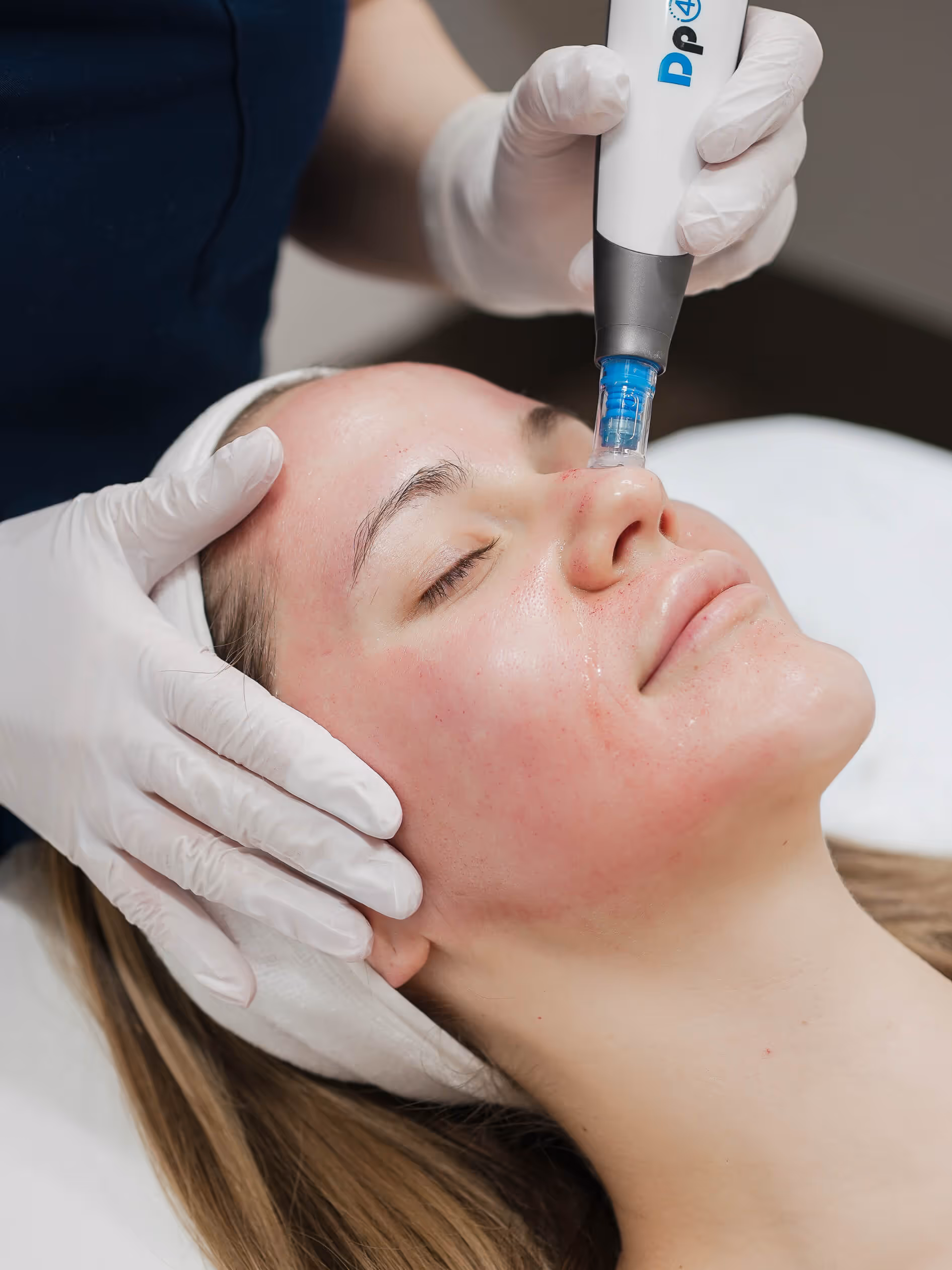 Microneedling