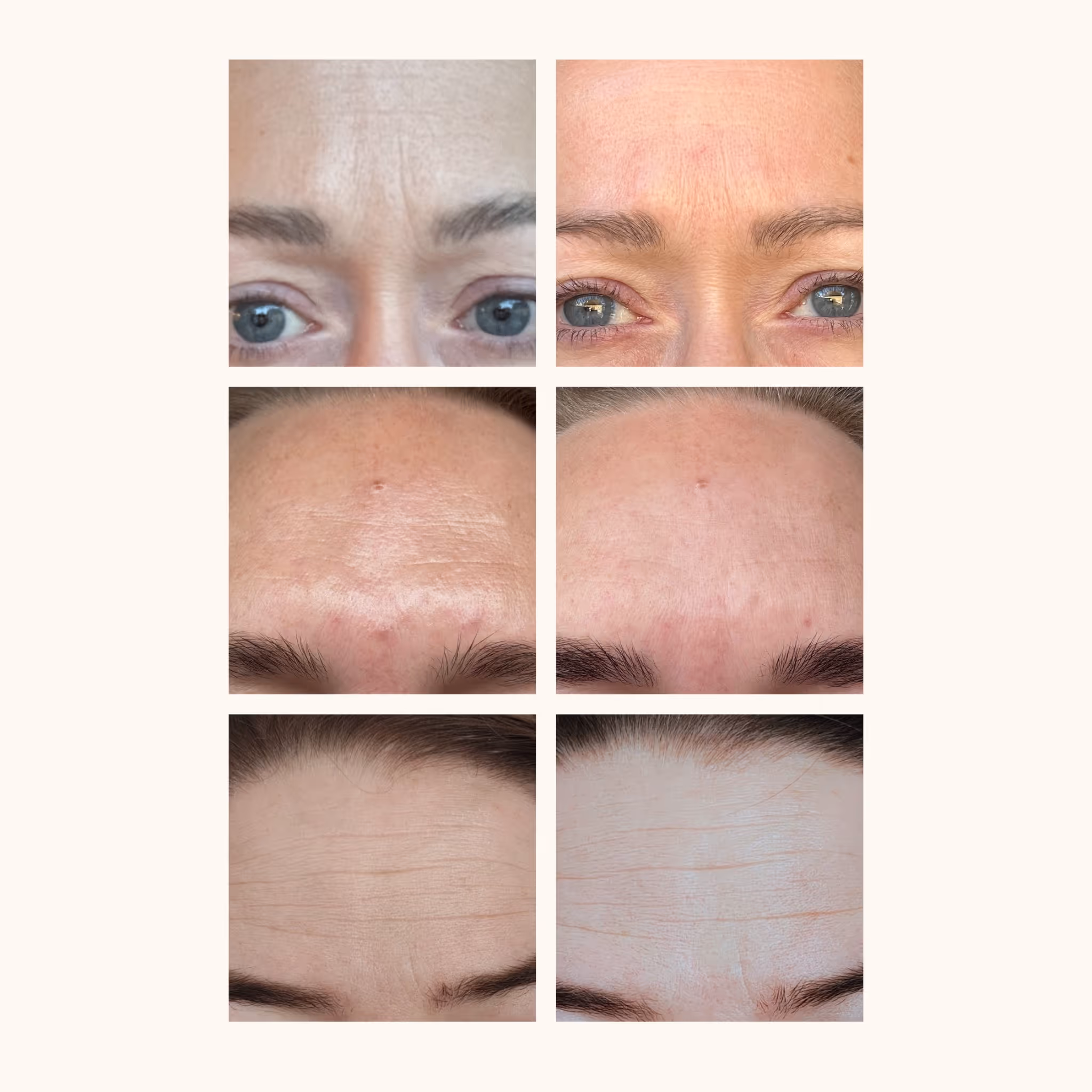 Före- och efterbilder när Glowaddictions testpanel testade facetape som ska vara ett alternativ till botox enligt vissa