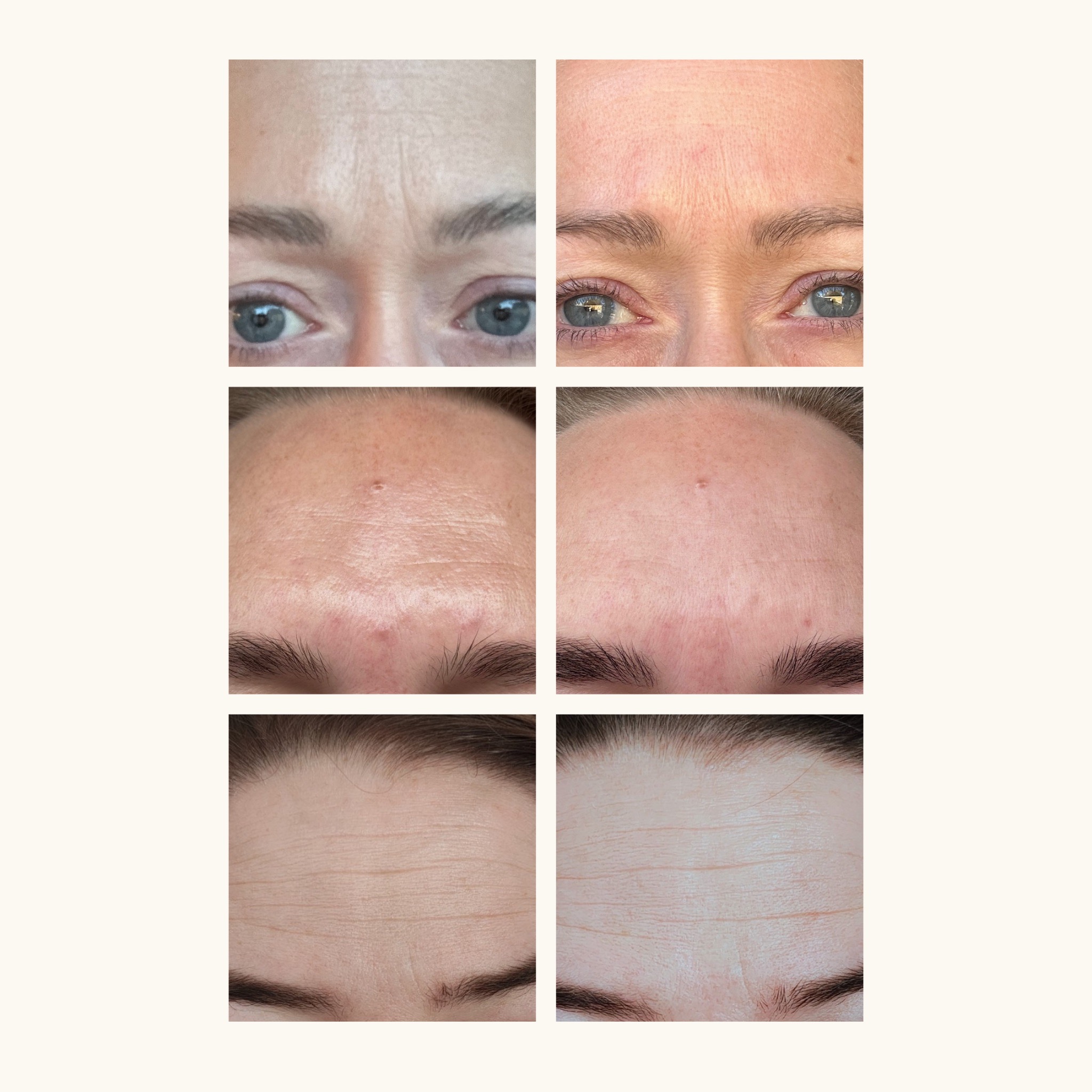 Före- och efterbilder när Glowaddictions testpanel testade facetape som ska vara ett alternativ till botox enligt vissa