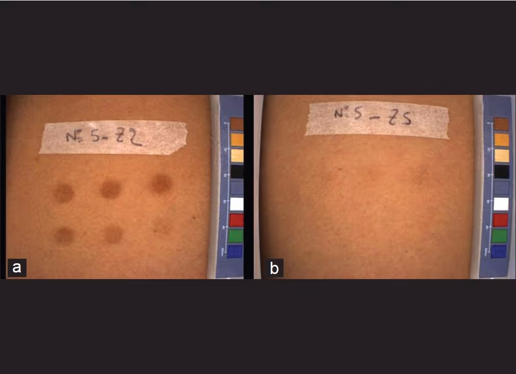 Bilden är en jämförelsebild som visar hur solskador uppstår när man inte skyddar sig mot UVA-strålning