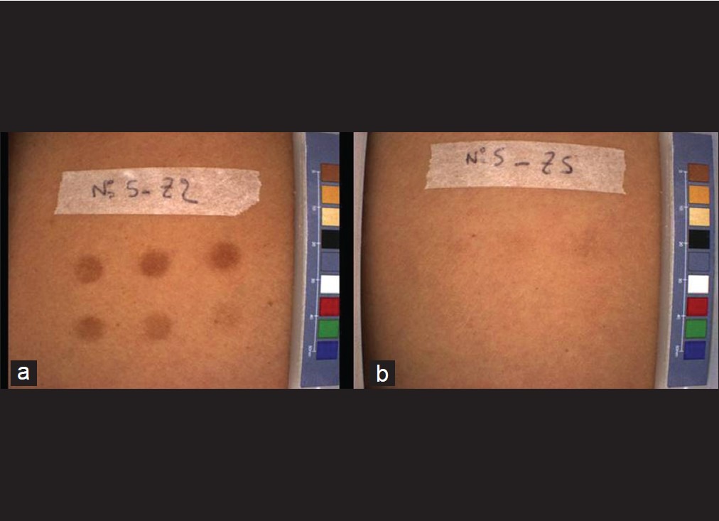 Bilden är en jämförelsebild som visar hur solskador uppstår när man inte skyddar sig mot UVA-strålning