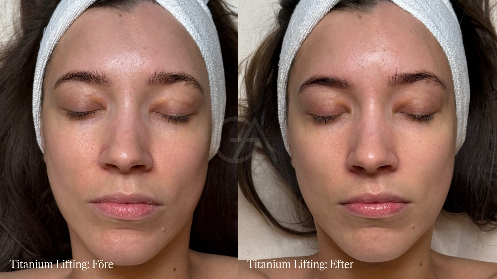 Före och efter Titanium lift: Mer glow i huden, Lina Livian har testat Titanium lift, efter titaniumlift har huden mer glow