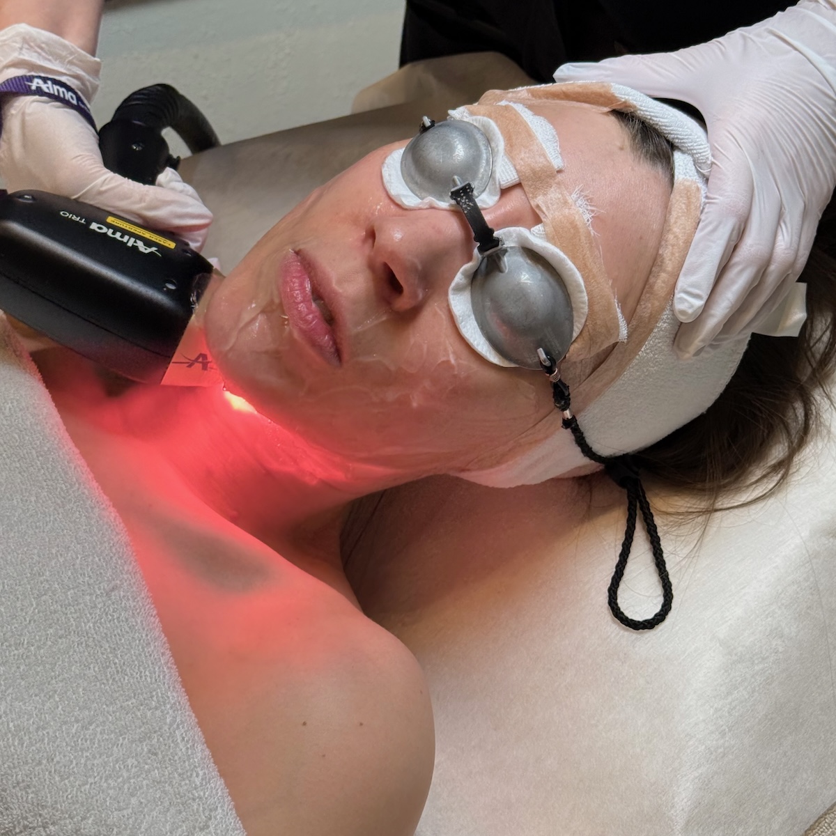 Bästa ansiktsbehandlingen bröllop, Lina Livian behandlas med Titanium Lifting