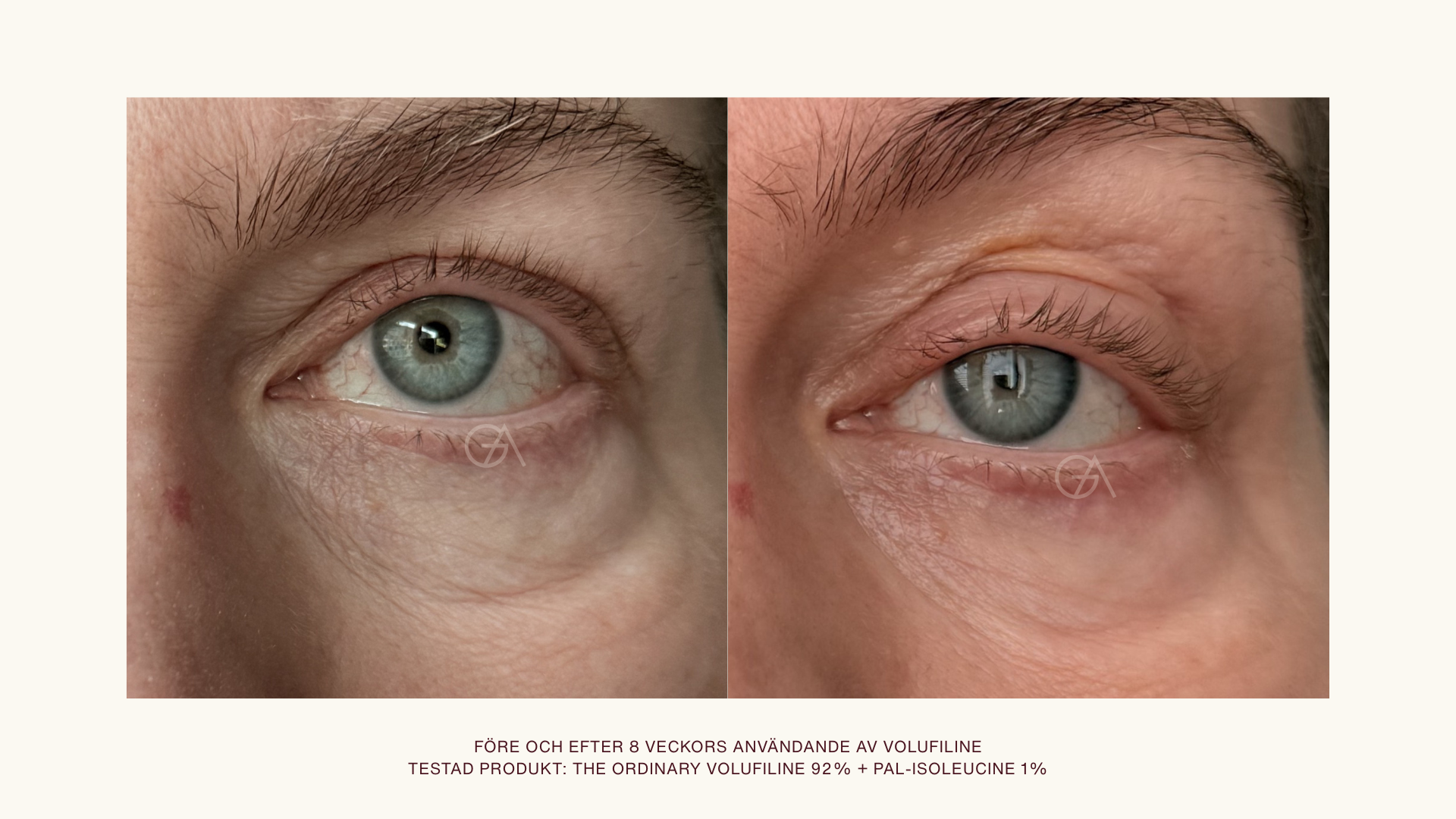 Volufiline ögonen före och efter, till vänster före åtta veckors användning av volufiline, till höger syns resultatet efter 8 veckor.