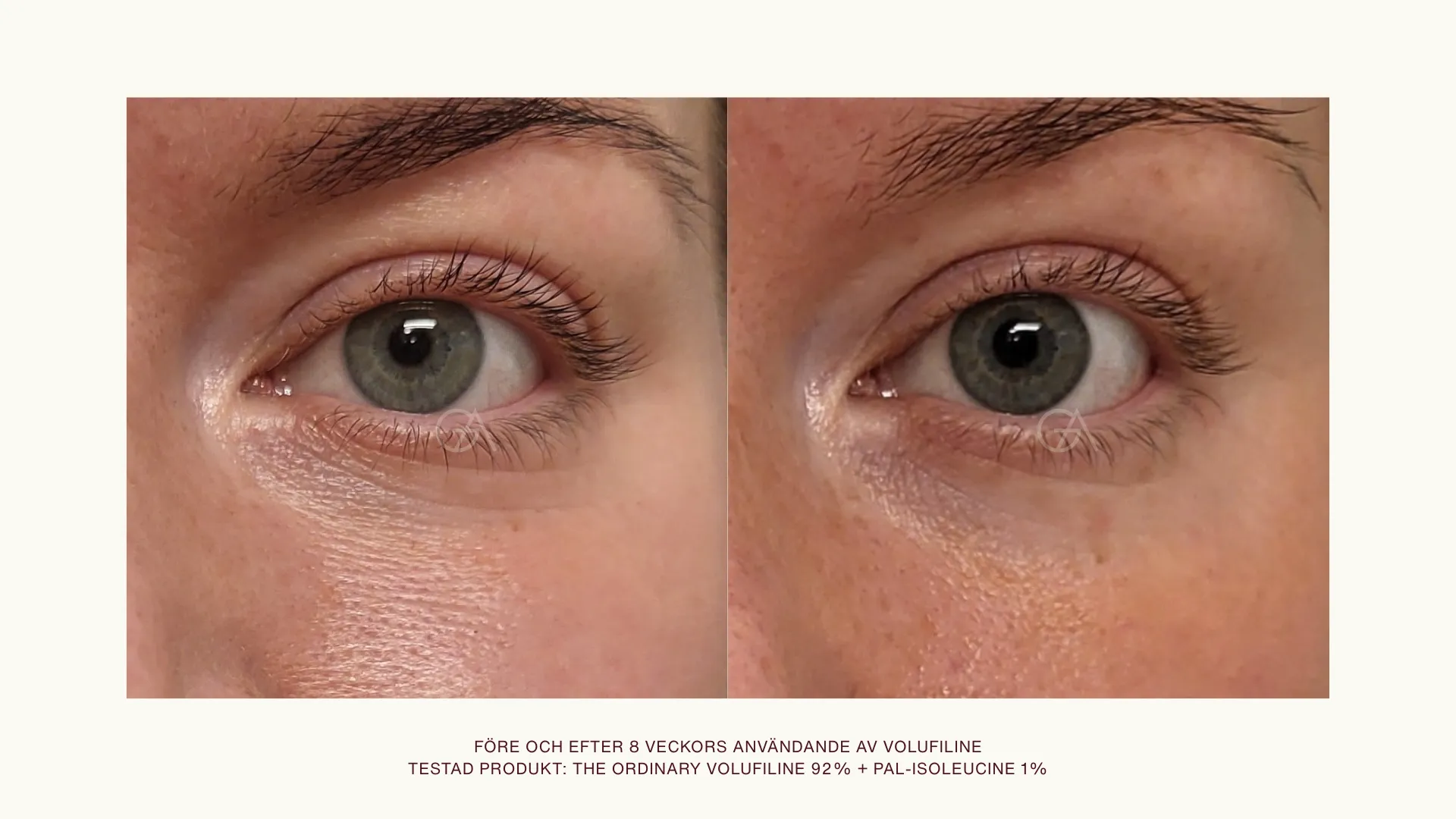 Volufiline före och efter, ögonområdet. Till höger syns före 8 veckors användning av volufiline runt ögonen, till höger syns efter.
