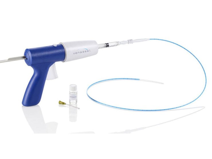 Venaseal Glue Treatment