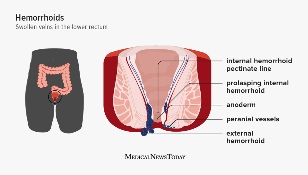 Hemorrhoids: Symptoms, causes, and treatments