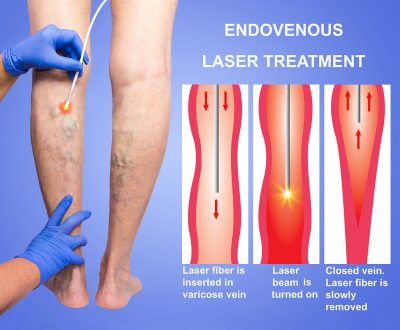 varicose veins treatment