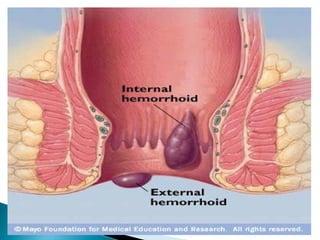 Hemorrhoids 
