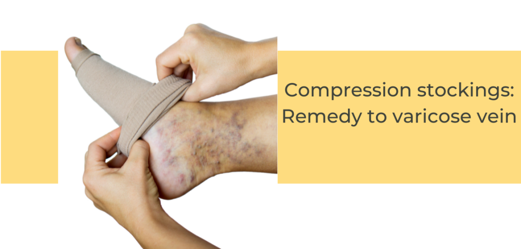 varicose veins