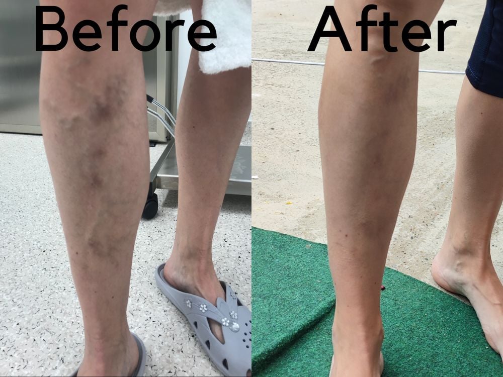 Venaseal Closure System (Medical Glue) - Varicose Veins Doctor
