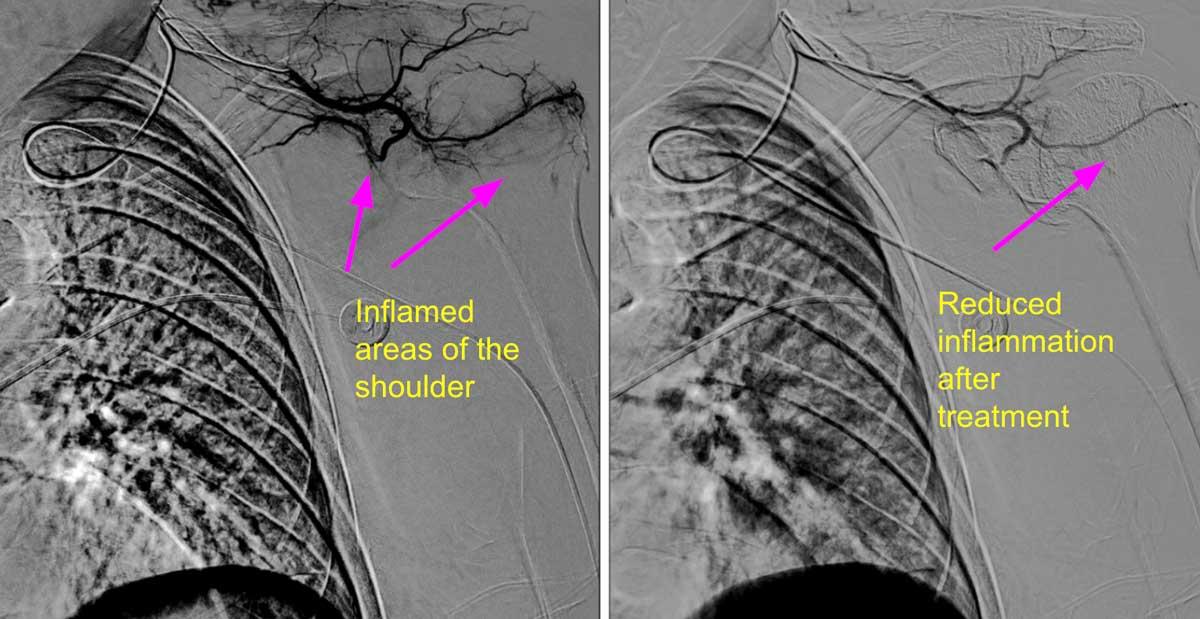 Embolization for Treatment of Frozen Shoulder | ReNew Vascular ...