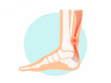 TOA | Foot & Ankle | Achilles Tendon Rupture | TOA