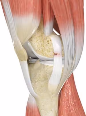 Knee Ligament Injuries Wellington | Distal Femur Fracture | Knee Pain FL