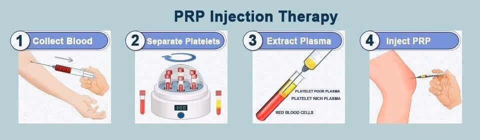 PRP INJECTIONS IN ORTHOPEDICS - Dr Naveen Reddy