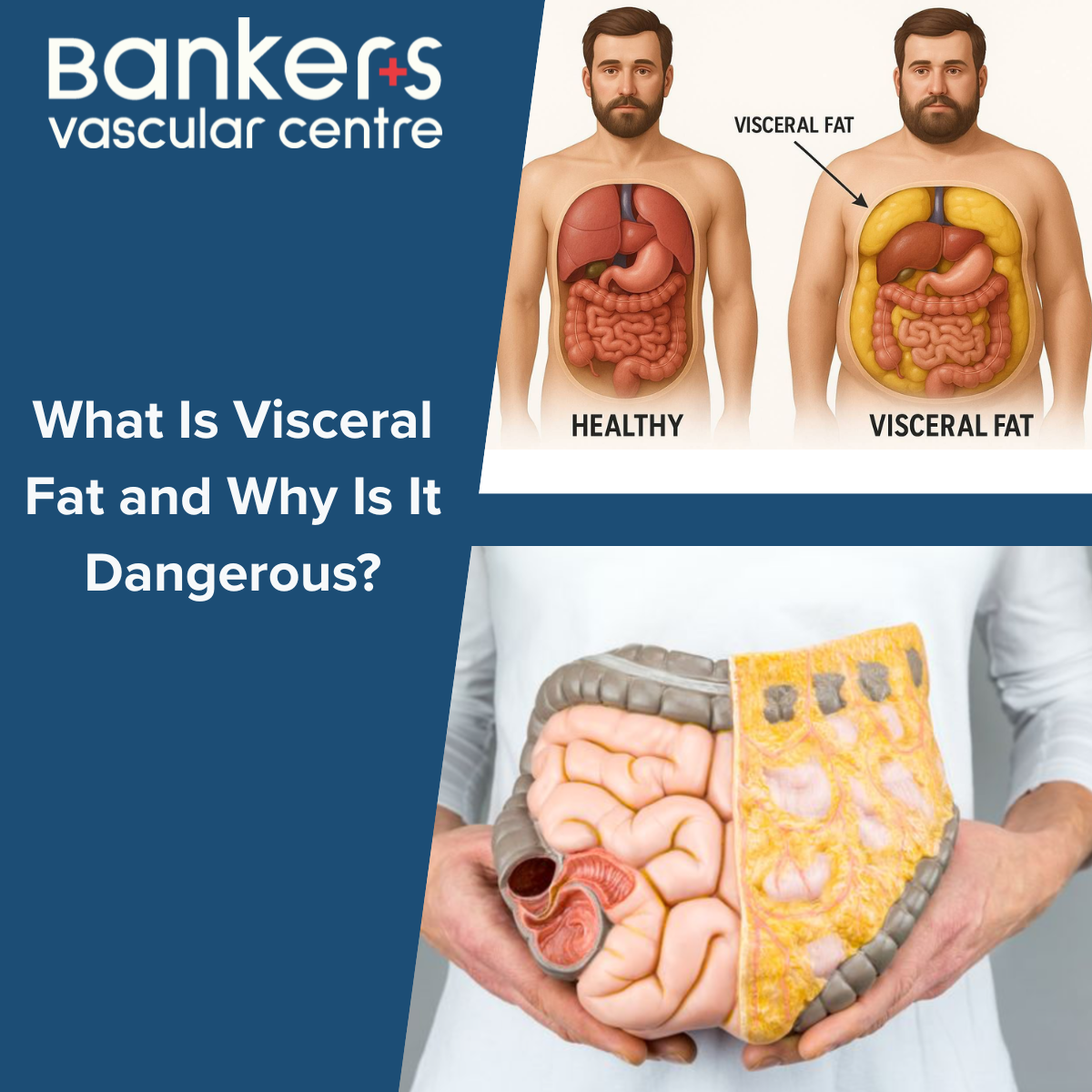 What Is Visceral Fat and Why Is It Dangerous? | Bankers Vascular Centre ...