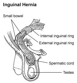 https://upload.wikimedia.org/wikipedia/commons/1/11/Inguinalhernia.gif