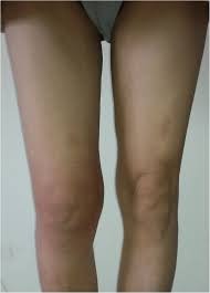 https://www.researchgate.net/publication/346525803/figure/fig1/AS%3A963891760750594%401606821112603/The-right-knee-joint-was-obviously-swollen-in-the-standing-position.png