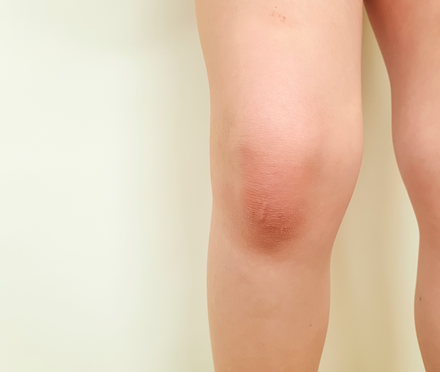https://hips.hearstapps.com/hmg-prod/images/swollen-knees-1566317866.png