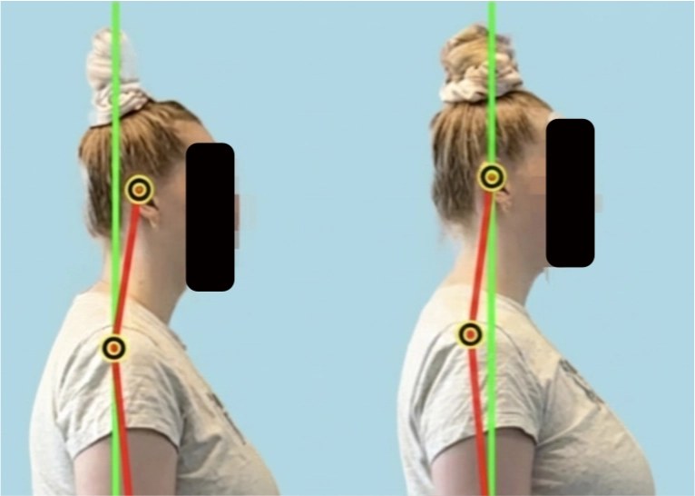 Side profile illustrating a neck hump and forward head posture